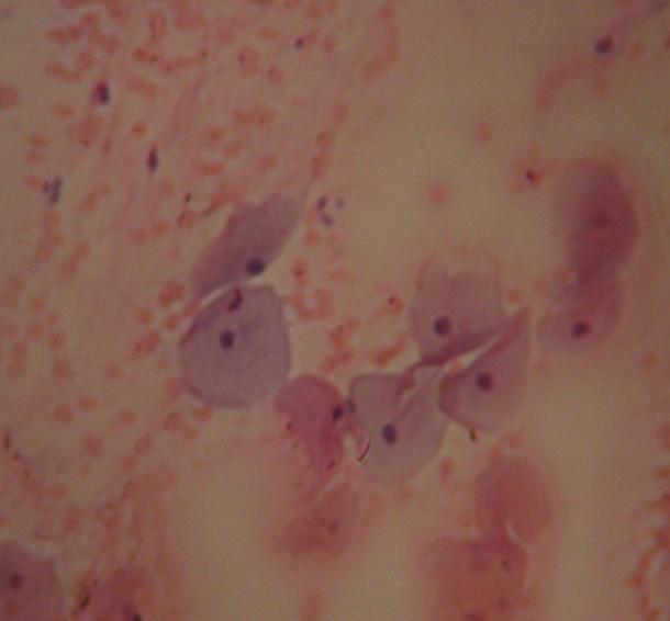 Photomicrograph of cervical smear fixed with Hairspray. Note the well outlined nuclear appearance (N),Papanicolaou Stain MgX 2.Leica microscope 4. Figure 2.