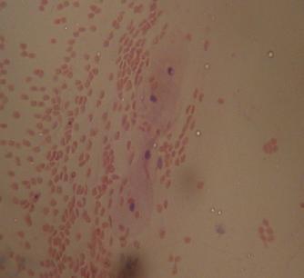 Figure 3. Photomicrograph of a section of showing same sample of cervical smear as in figure 1 and 2 but fixed in 95% ethyl alcohol. Note the preserved RBC s (R) obscuring epithelial cells. (EC).