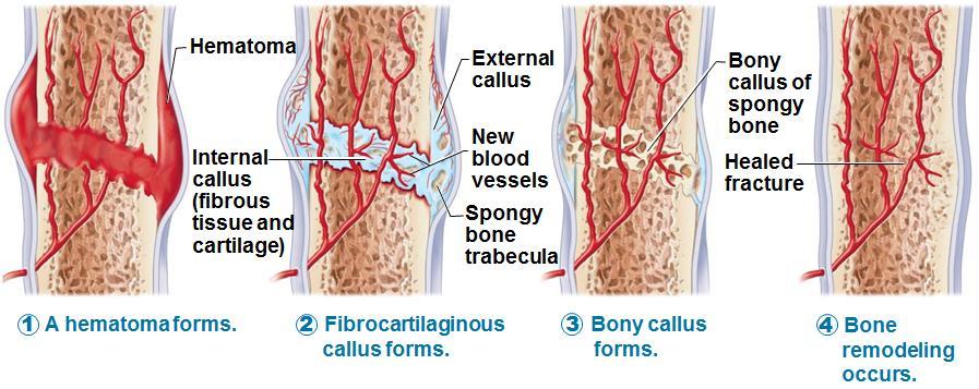 Stages in the Healing of a Bone Fracture 1. Hematoma formation a mass of clotted blood forms at fracture site and tissue becomes swollen, painful and inflamed. 2.