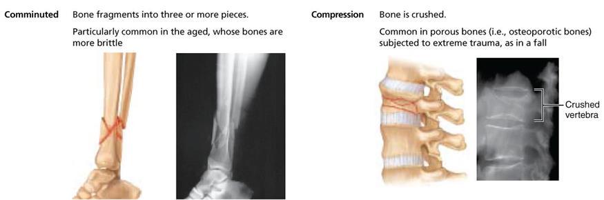 Bone FRACTURES classified by: The position of the bone ends
