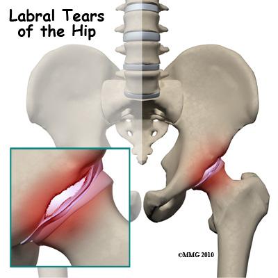 Introduction Acetabular labrum tears (labral tears) can cause pain, stiffness, and other disabling symptoms of the hip joint. The pain can occur if the labrum is torn, frayed, or damaged.