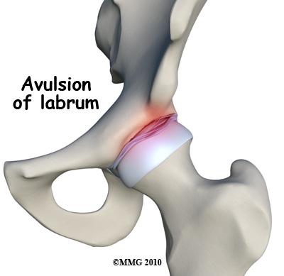 The labrum helps seal the hip joint, thus maintaining fluid pressure inside the joint and providing the overall joint cartilage with nutrition.