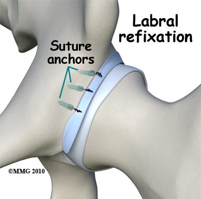 Surgery Arthroscopy is commonly used to repair the torn labrum. The arthroscope is a small fiberoptic tube that is used to see and operate inside the joint.