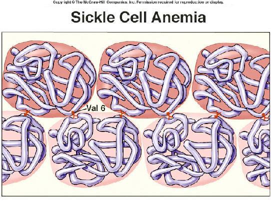 In sickle cell anemia, the normal hemoglobin molecule mutates by exchanging the 6th amino acid on the beta chain from glutamic acid to valine. Normal b has the genotype SS.