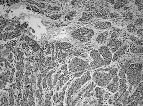 268 Kim JH, et al. Immunohistochemically, expression of epithelial membrane antigen (EMA) and MUC-1 (Fig. 2C) was observed at the stromal edge of the micropapillary tumor cells.