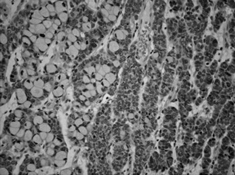 Intermingled or transitional areas between these components were noted. On immunohistochemistry, the neuroendocrine components were positive for CD56, synaptophysin, chromogranin, and CK (Fig. 4A).
