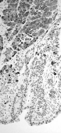 (C) Adenocarcinoid cells were diffusely positive for CEA, but intermixed neuroendocrine carcinoma cells were negative (A~C: immunohistochemistry stain, 200).