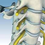 This is called degenerative disc disease. As the disc collapses, the spine may lose its normal alignment.
