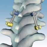 During the procedure, your surgeon may remove part of the vertebra or bone spurs that are pinching the