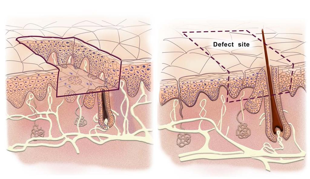 The epidermis is regenerative Figure by MIT OCW. Spontaneous regeneration of excised epidermis Left: a controlled injury (e.g. stripping or blistering) which leaves the dermis intact.