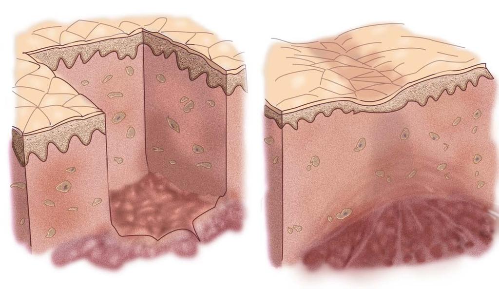 The dermis is nonregenerative Spontaneous healing of skin excised to full thickness by contraction and scar formation. The dermis does not regenerate. Figure by MIT OCW.