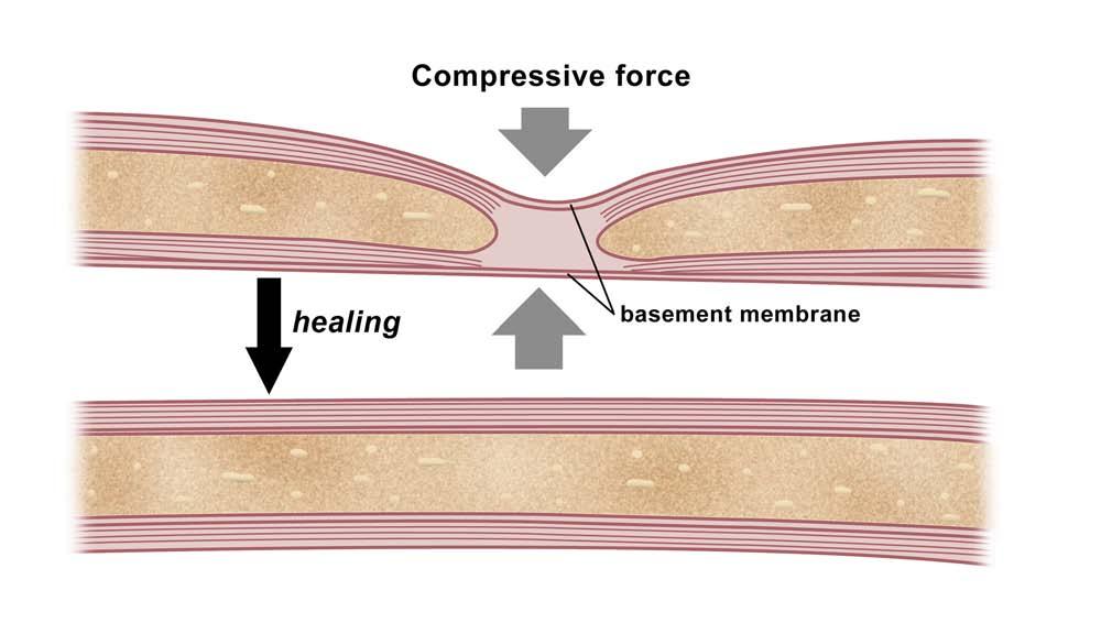 crushed nerve heals spontaneously by regeneration Figure by MIT OCW. Within the nerve fiber, axons and their myelin sheath are regenerative.