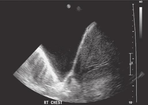 18-Levitov_CH18_p230-246.qxd 3/31/10 4:24 PM Page 240 240 Bedside Ultrasonography in Clinical Medicine X Figure 18.14. Anechoic appearance indicates an uncomplicated transudative pleural effusion.