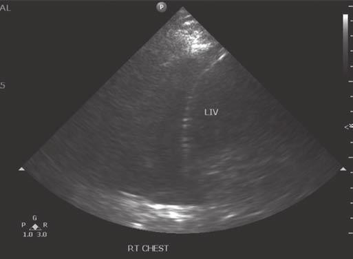 anteriorly, laterally, and posteriorly; the mediastinum medially; and the diaphragm inferiorly. From a sonographic viewpoint, only the anterior, lateral, and posterior borders are accessible.