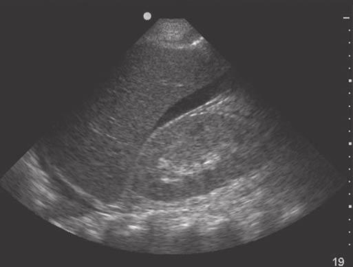18-Levitov_CH18_p230-246.qxd 3/31/10 4:24 PM Page 241 Ultrasound Guidance for Common Procedures 241 Figure 18.17. Appearance of fluid in the hepatorenal recess.