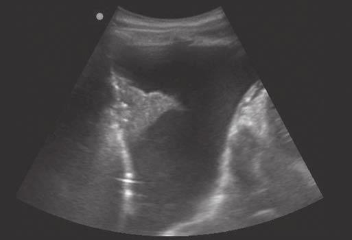 18. Appearance of pleural fluid confirmed by the presence of the diaphragm (hyperechoic line on the left) and the collapsed lung (compression atelectasis [white arrow]).