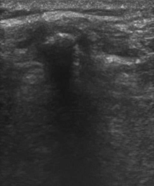 31/10 4:24 PM Page 238 238 Bedside Ultrasonography in Clinical Medicine TABLE 18.3. Advantages of Using Ultrasound Guidance for Lumbar Puncture Allows visualization of the interspace and the exact