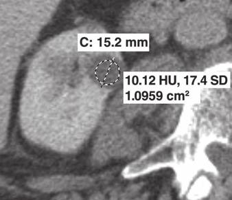 41 HU) in lower pole of right kidney. B, Transverse contrast-enhanced nephrographic phase CT scan shows cyst measures 10.12 HU. C, Follow-up CT scan obtained 18 months after B shows cyst is stable.