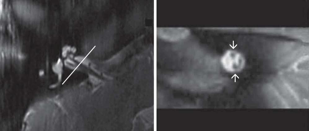 dark dot in the white circle (IAC). A, The size of the cochlear nerve is measured against the facial nerve superior to it.