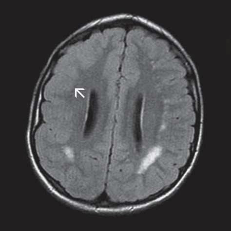 An infiltrating enhancing mass is present within the left middle cerebellar peduncle (arrow in B and C). Diagnosis was juvenile pilocytic astrocytoma.