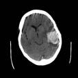 CT: 6x2 cm ICH, 5mm midline shift, IVH One Week s VUMC ICH Admissions: CT Imaging of