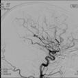 Arteriogram Reversible cerebral vasoconstriction syndrome RCVS is a spectrum of disorders characterized by prolonged by reversible vasoconstriction associated with thunderclap headache.