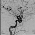 Associated with ischemic or hemorrhagic stroke, also convexity SAH Thought to be due to autoregulation failure of cerebral arterial tone with sympathetic overactivity, which may begin distally and