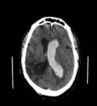 w/ stroke (46 ischemic, 63 ICH) prospective EEG monitoring x 72 hrs. Seizures occurred in 28% w/ich, vs 6% w/ischemic stroke (usually focal, 2 gen.) Sz s associated w/nihss worsening (14.8-18.