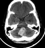 Cerebellar hemorrhage Mortality related to size, location, compression of adjacent brainstem structures smaller, more lateral better outcome <10% of ICH s are cerebellar Abrupt onset HA, N/V, ataxia,