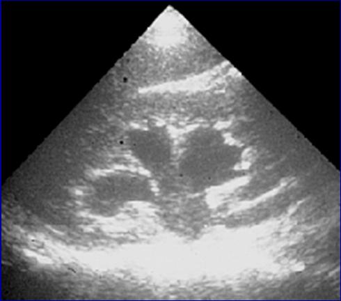 Imaging in a child with UTI