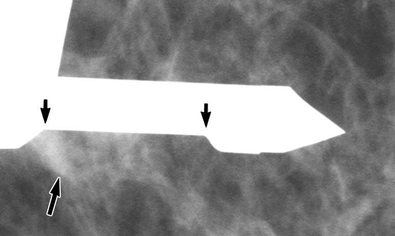 Mass (long arrows) is at sampling notch (short arrows). F, Mammogram obtained after sampling shows biopsy cavity (short arrows) at mass (long arrows). Mass is now smaller.