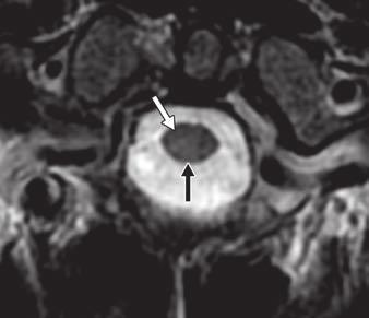 T2-weighted FSE as true-positive lesions and those on MERGE as false-positive lesions.
