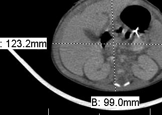 Magnification Error Measure AP or LAT dimen- sion from axial scan view.