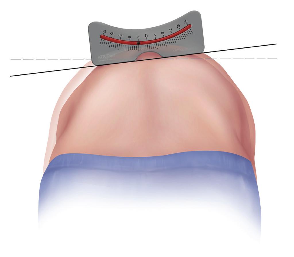 of trunk rotation that is less than 5 degrees is insignificant and may not require followup. 4,5 A measurement of 5 to 9 degrees at least warrants reexamination in six months.