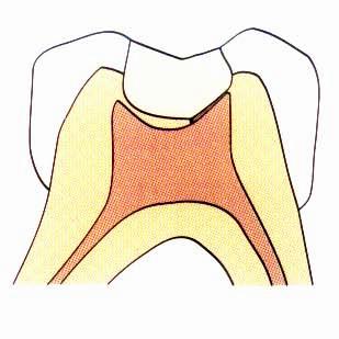 During cavity preparation, Following a traumatic injury Due to caries,