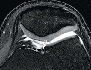 There is also deep chondral erosion (grade III) on the medial facet (arrowhead).