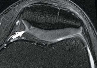 (C) Chondral fissure affecting more than 50% of the total thickness of the medial facet of the patella, indicating grade III chondropathy (arrow).