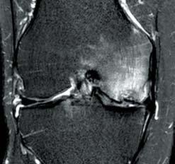 344 6A 6B 6C Figure 6 Subchondral abnormalities seen on MRI. Coronal fast-saturated MRI on the knee, with T2 weighting (A and B) and T1 weighting (C).