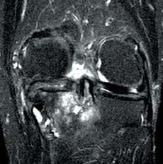 (B) Femorotibial degenerative arthropathy with subchondral cysts and bone marrow edema on the medial tibial plateau.