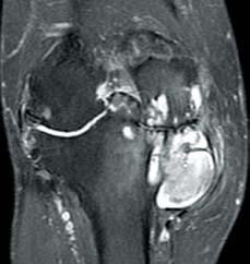 Medial femorotibial degenerative arthropathy associated with extrusion of the medial meniscal body, which presents signal elevation and synovitis