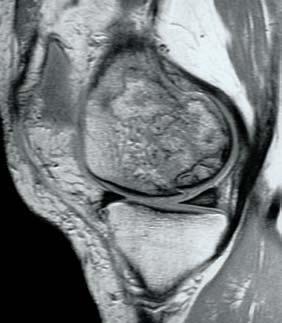 MRI EVALUATION OF KNEE CARTILAGE 345 9A 9B Figure 9 Osteonecrosis of the femoral condyle.