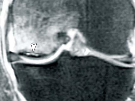 (B) Coronal T2-weighted MRI with fat saturation showing severe degenerative arthropathy with bone necrosis on the medial femoral condyle, associated with a fracture of the adjacent subchondral