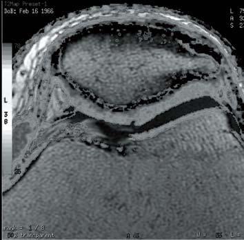 structural damage to the chondral matrix. A small fissure on the medial facet is also seen (arrowhead).