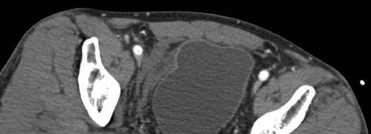 MDCT CT Cystogram Technique