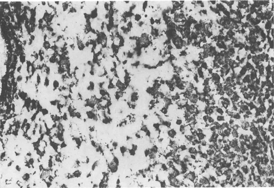 180 CANCER July 1 1980 Vol. 46 FIG. 2. Cryostat section from chondroblastic osteosarcoma. Tumor cells all contain abundant alkaline phosphatase, shown black in monochrome, ringing the nuclei.