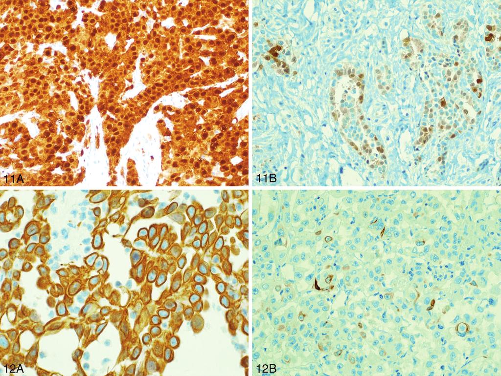 Figure 11. A and B, Calretinin staining. A, Malignant mesothelioma has diffuse strong nuclear and cytoplasmic positivity.
