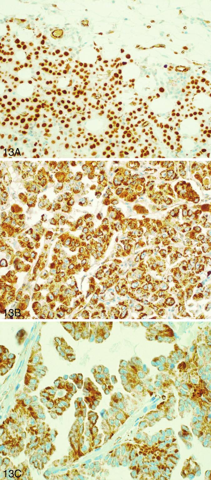 Figure 13. A through C, Wilms tumor 1 (WT-1) staining. A, Strong nuclear staining in malignant mesothelioma invading fat. Note that endothelial cells show cytoplasmic staining only.