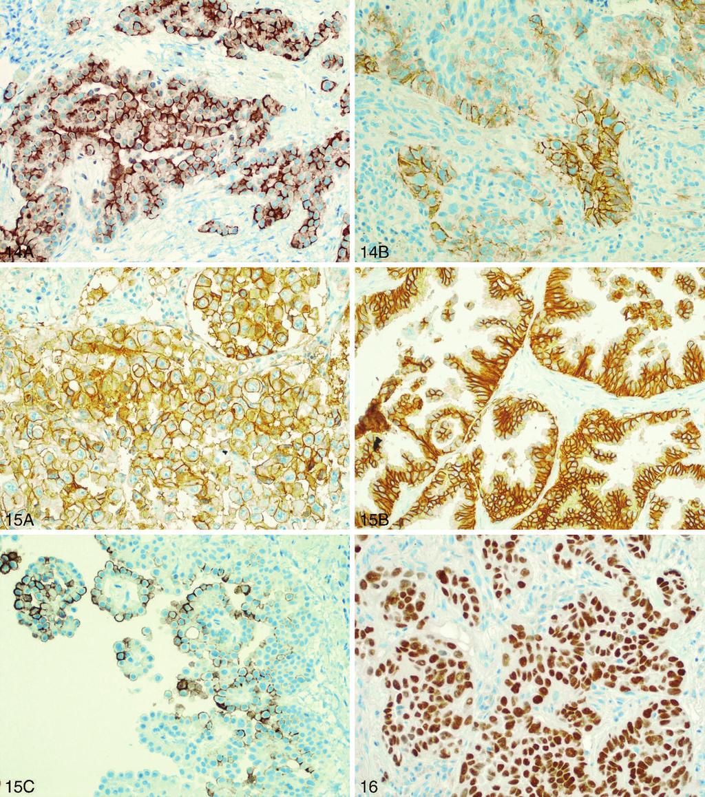 Figure 14. A and B, D2-40 staining. A, Strong membranous staining in malignant mesothelioma. B, Focal staining in squamous cell carcinoma (original magnifications 3200 [A] and 3400 [B]). Figure 15.