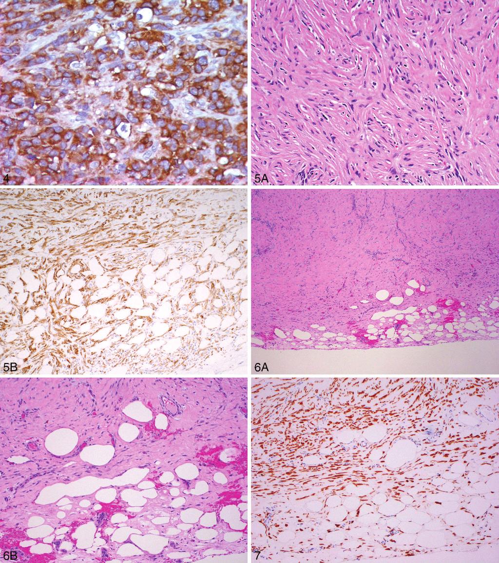 Figure 4. Epithelioid malignant mesothelioma with strong cytoplasmic staining for insulin-like growth factor II messenger RNA binding protein 3 (IMP3) (original magnification 3400). Figure 5.