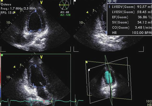 echocardiographic variables in a single center. Subjects and Methods Study protocol and subjects This study comprises a prospective, randomized but unblinded medication trial.